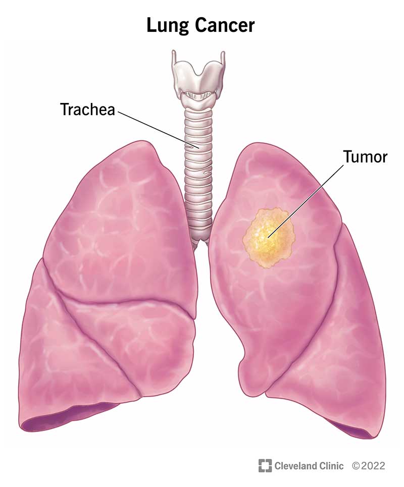 4375-lung-cancer